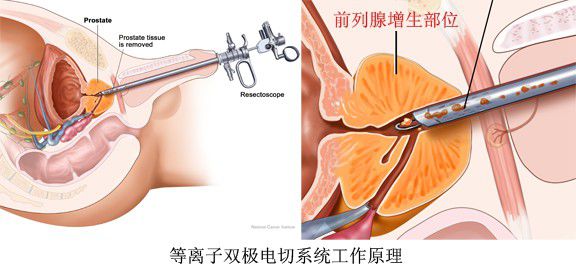 前列腺增生治疗方法